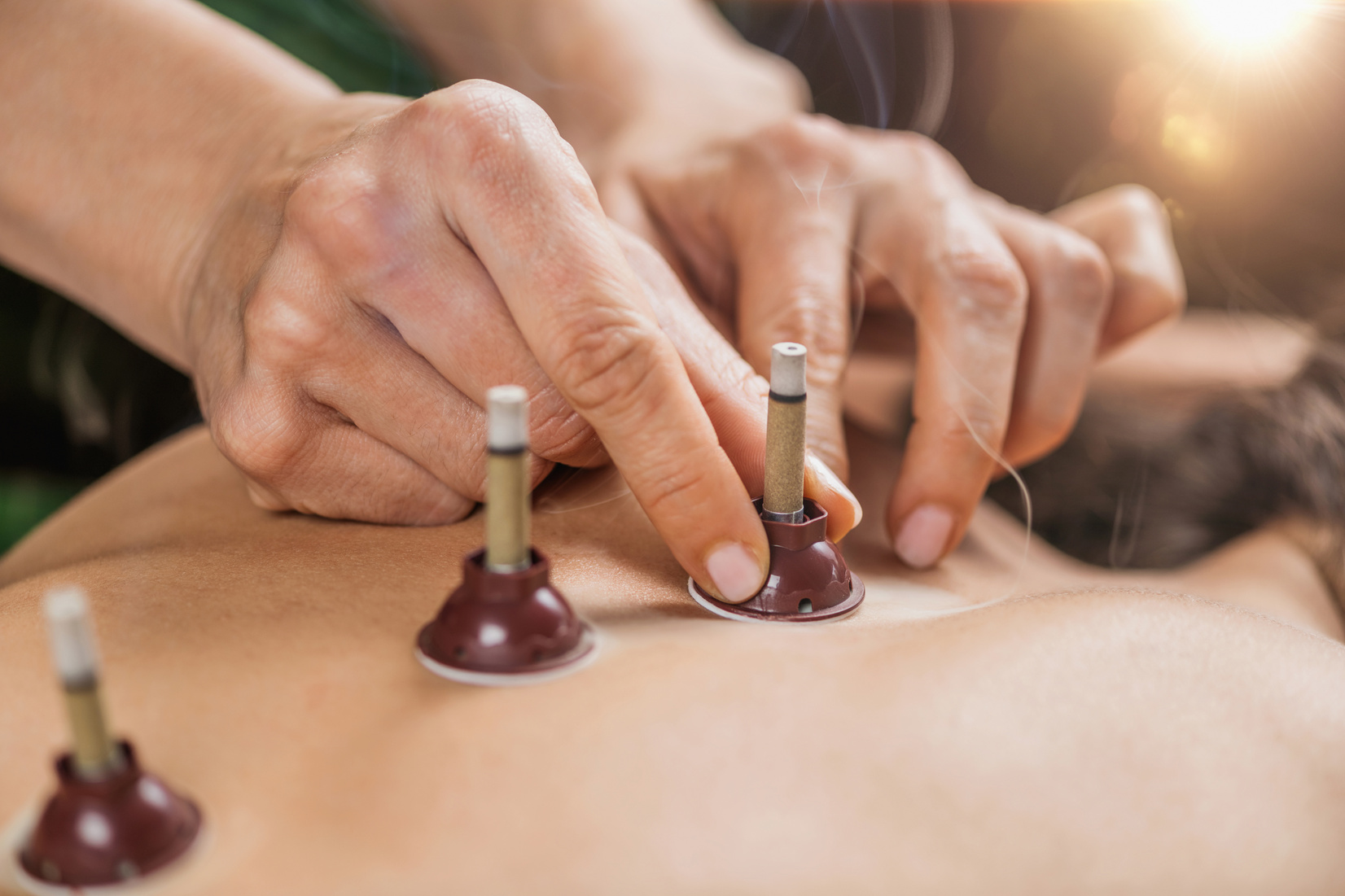 Moxibustion Therapy – Traditional Chinese Medicine